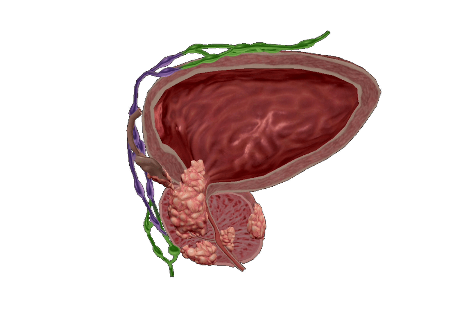 Cancer progression sequence